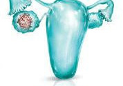 Что такое онкомаркеры? Что такое тест CA 125?